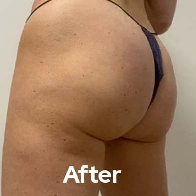 Glute builder, abs, arms or thighs at Nurse Ink/Rao Med Spa in Covington, LA