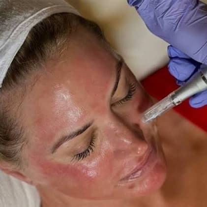 Microneedle/Facial package at Nurse Ink/Rao Med Spa in Covington, LA