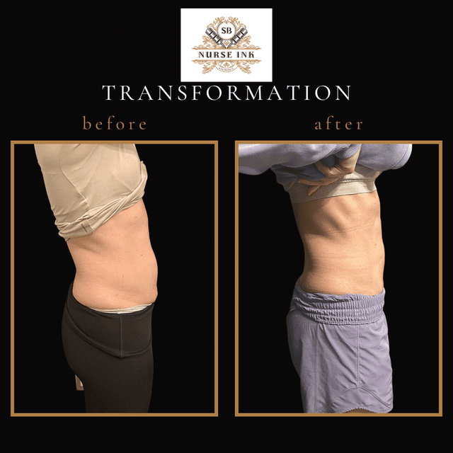 Summer Transformation at Rao Med Spa/Nurse Ink in Covington, LA